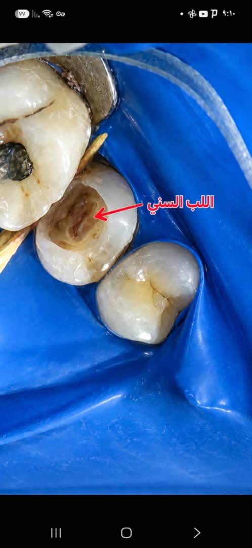 تقرير من العيادة السنية عن المعالجة اللبية الحيوية والمتابعة — صورة 3